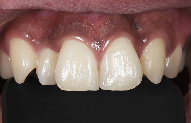 千葉県茂原市の歯医者、たけ歯科クリニックのなるべく削らず、歯を守る治療