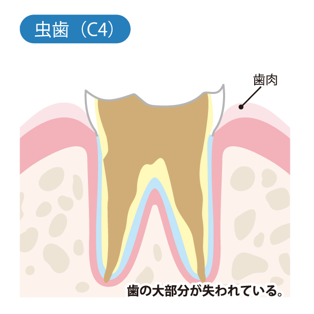 千葉県茂原市の歯医者、たけ歯科クリニックのむし歯治療