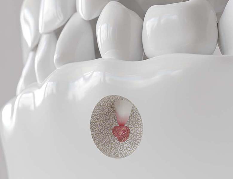 千葉県茂原市の歯医者、たけ歯科クリニックのなるべく削らず、歯を守る治療