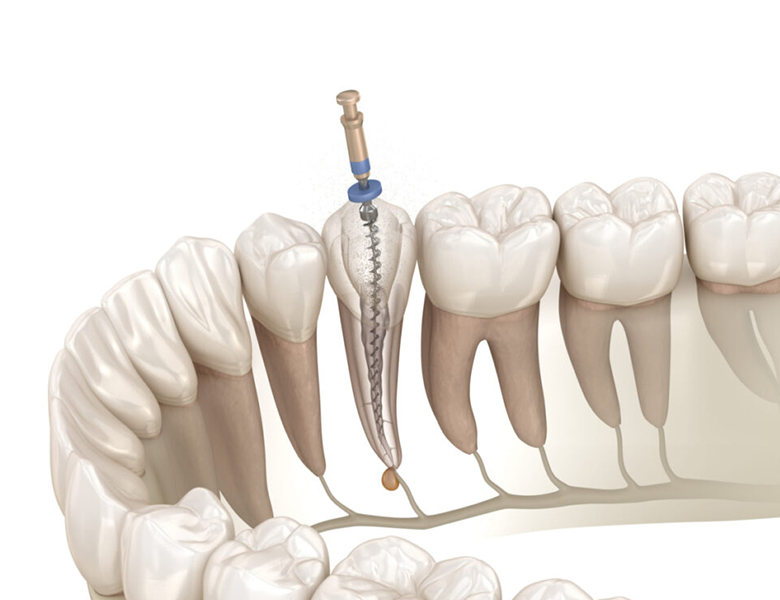 千葉県茂原市の歯医者、たけ歯科クリニックの根管治療