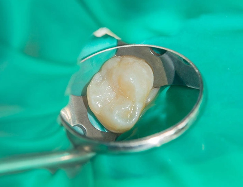 千葉県茂原市の歯医者、たけ歯科クリニックの根管治療